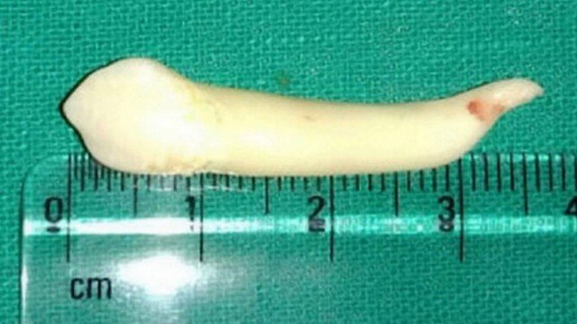 Vampiro? Dentista indiano bate recorde e arranca dente de 3,9cm