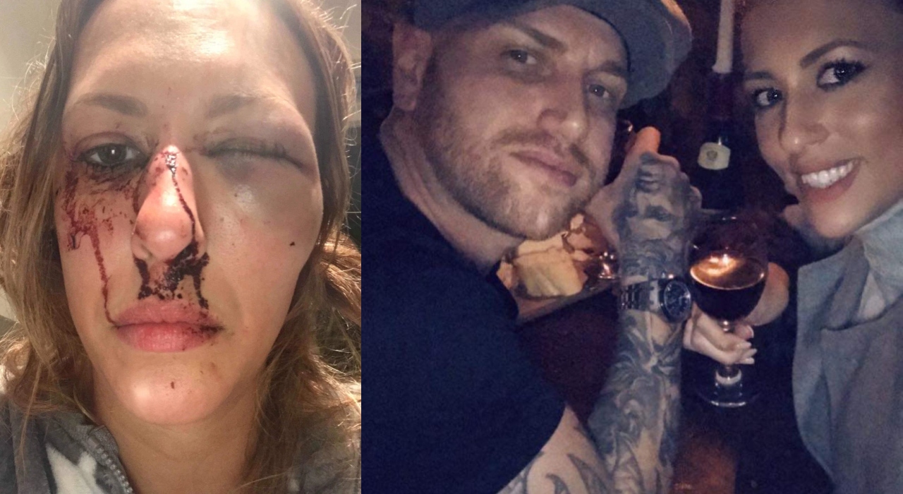 Mulher fica com rosto deformado após “vingança” do ex-namorado: “Prometeu estragar minha aparência”
