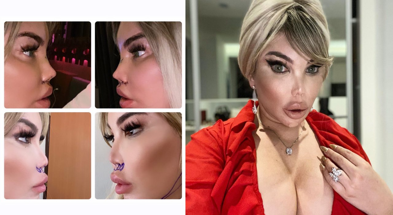 Jessica Alves, ex-Ken Humano, faz quinta cirurgia plástica em duas semanas