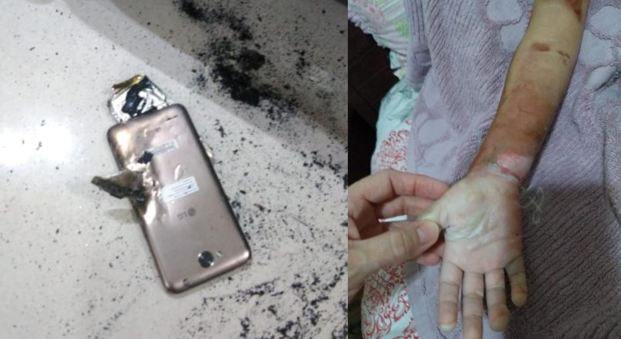 Criança de 5 anos sofre queimaduras após celular explodir
