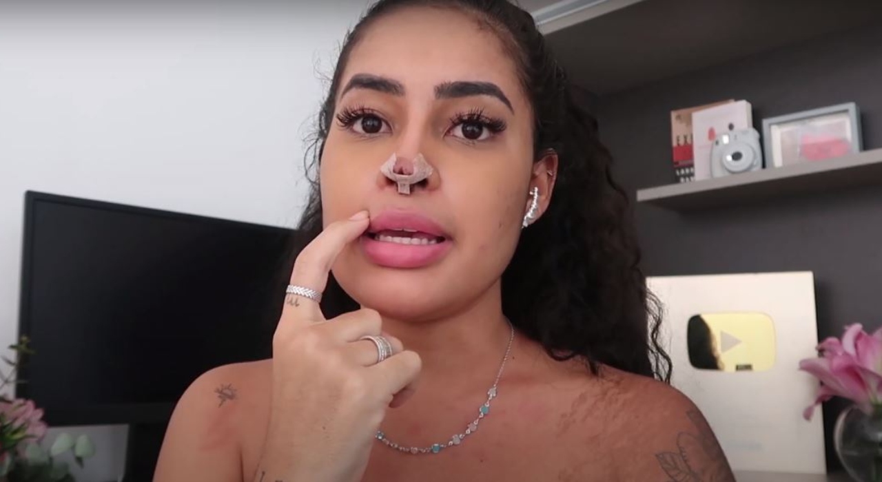 Influenciadora relata complicações de cirurgia desastrosa: “Meu nariz estava aberto”